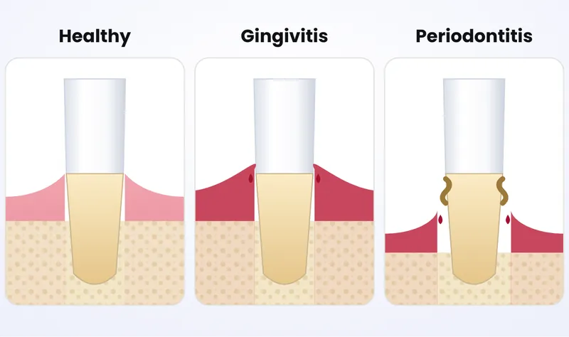 Illustration of three stages of gum disease: healthy gums, red swollen bleeding gums of gingivitis, and receding gums with bone loss in periodontitis