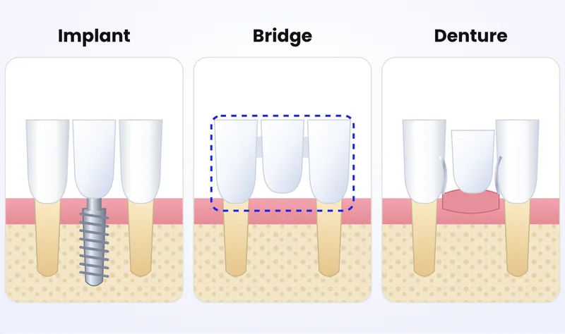 Illustration comparing a dental implant with a crown, a three-unit dental bridge resting on the neighbouring teeth, and a partial denture resting on the gum