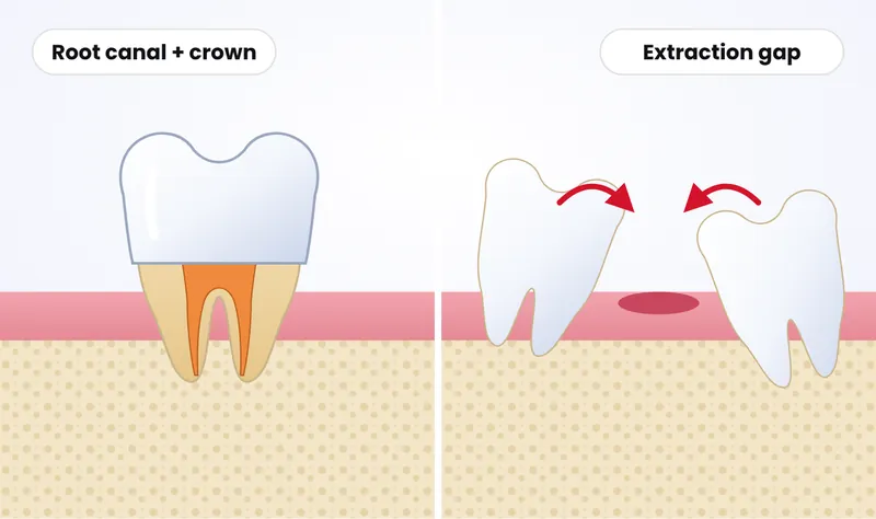 Illustration comparing a tooth saved with root canal treatment and a crown with a gap left after extraction, where the neighbouring teeth tilt into the space