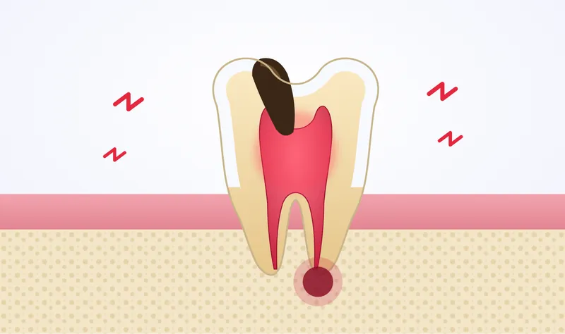 Illustration of a tooth cross-section with deep decay reaching the inflamed nerve and an abscess at the root tip