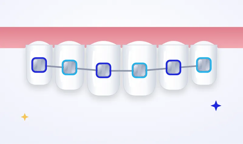 Illustration of fixed braces: brackets and an archwire straightening the upper front teeth