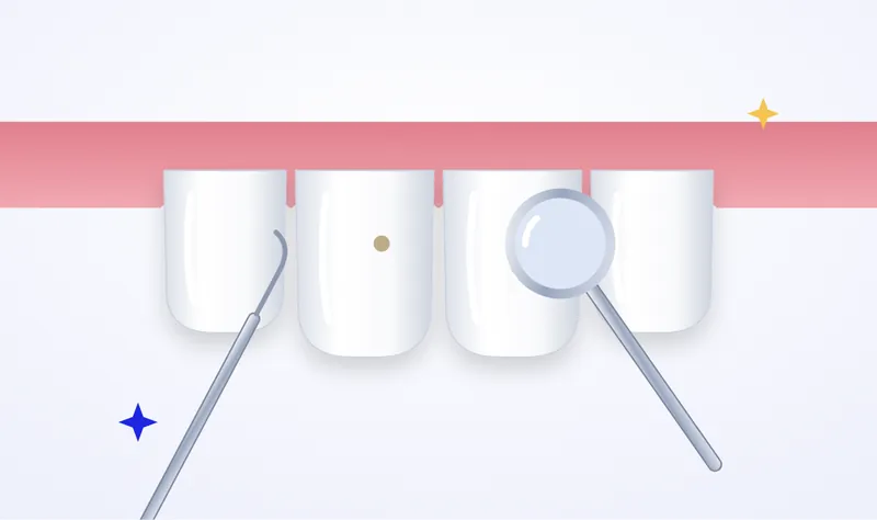 Illustration of a dental check-up: a dental mirror and probe examining teeth with early stains
