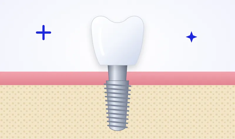 Illustration of a dental implant: a titanium post in the jaw bone with a ceramic crown on top