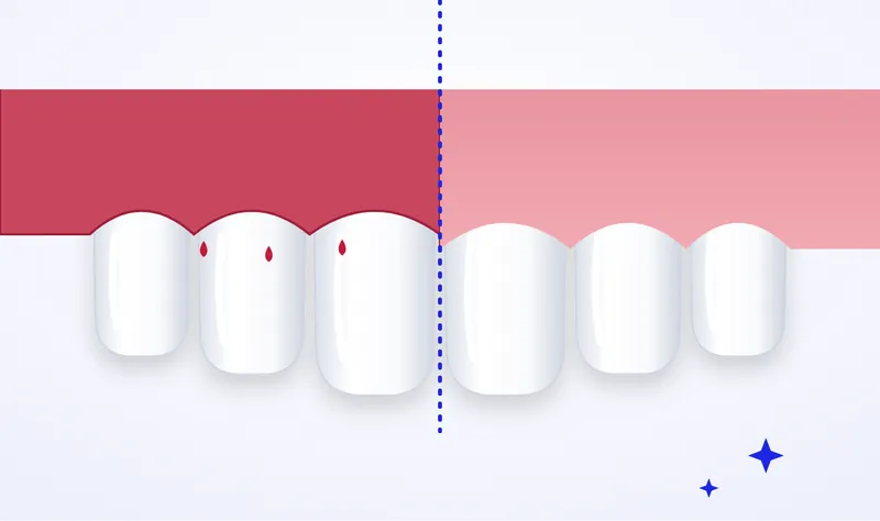 Illustration of gum disease: receding, inflamed and bleeding gums on the left beside healthy pink gums on the right