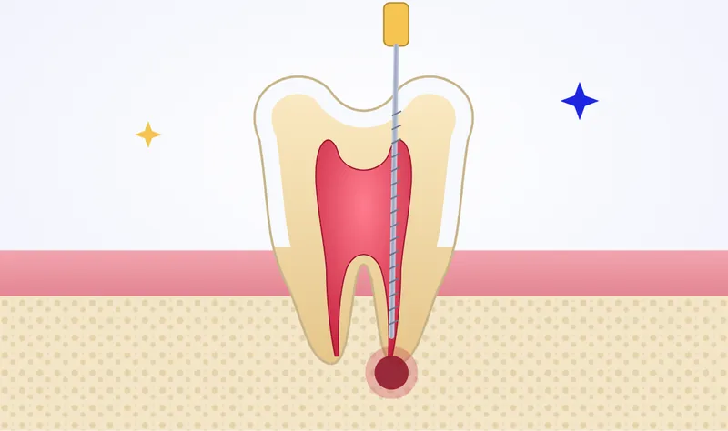 Illustration of root canal treatment: an infected tooth pulp with an abscess at the root tip being cleaned with an endodontic file