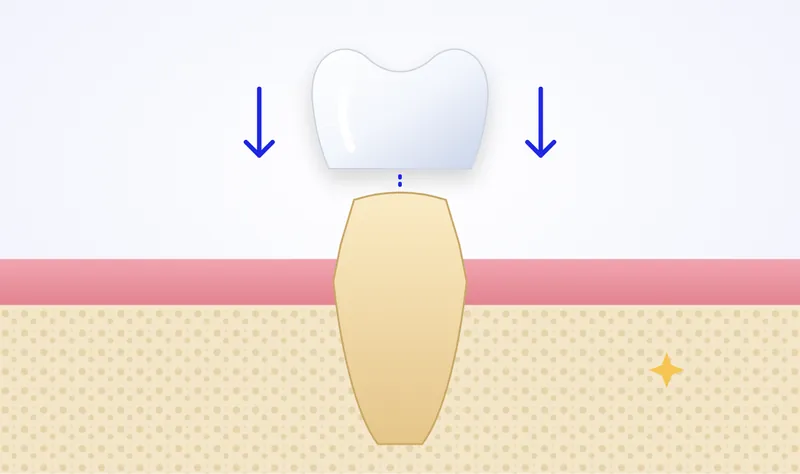 Illustration of a zirconia crown being fitted over a prepared tooth